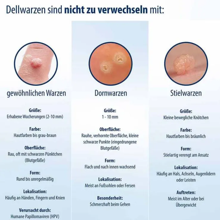 Evolsin Dellwarzen Mittel Lösung, 5 ml