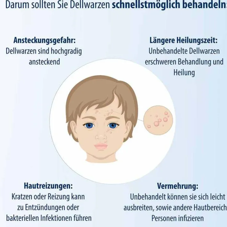 Evolsin Dellwarzen Mittel Lösung, 5 ml