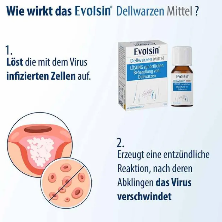 Evolsin Dellwarzen Mittel Lösung, 5 ml