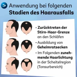 Minoxidil Dexcel 50 mg / ml Spray z.Anw.a.d.Kopfhaut, 60 ml