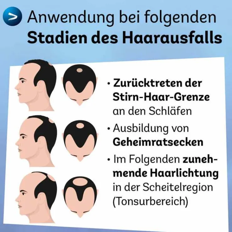 Minoxidil Dexcel 50 mg / ml Spray z.Anw.a.d.Kopfhaut, 60 ml