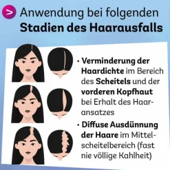 Clearance Dexcel Minoxidil 20 mg / ml Spray z.Anw.a.d.Kopfhaut, 3X60 ml