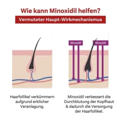 New MINOXIDIL 20 mg/ml Lösung für Frauen, 3X60 ml Mittel Gegen Haarausfall