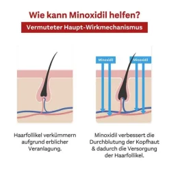 Outlet MINOXIDIL 50 mg/ml Lösung für Männer, 3X60 ml Mittel Gegen Haarausfall